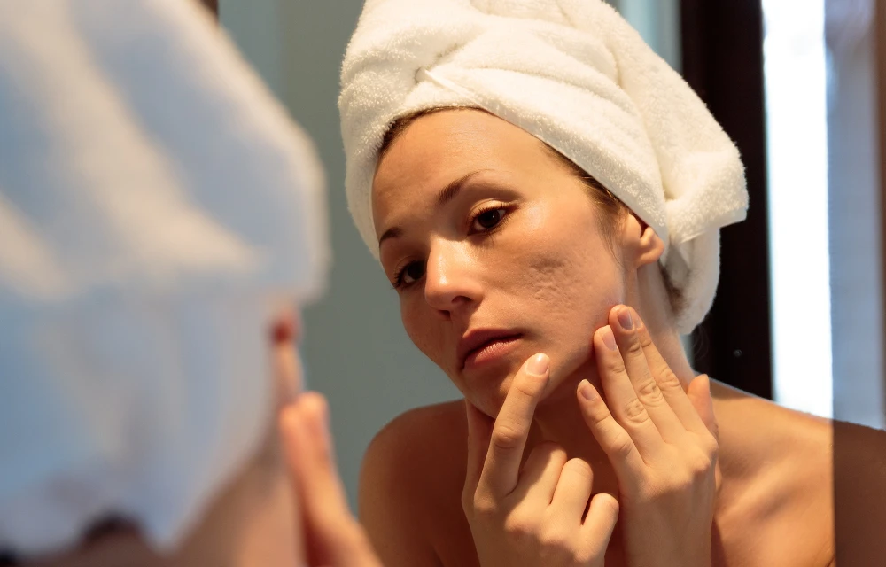 The Best Treatments for Acne Scars (That Actually Work)