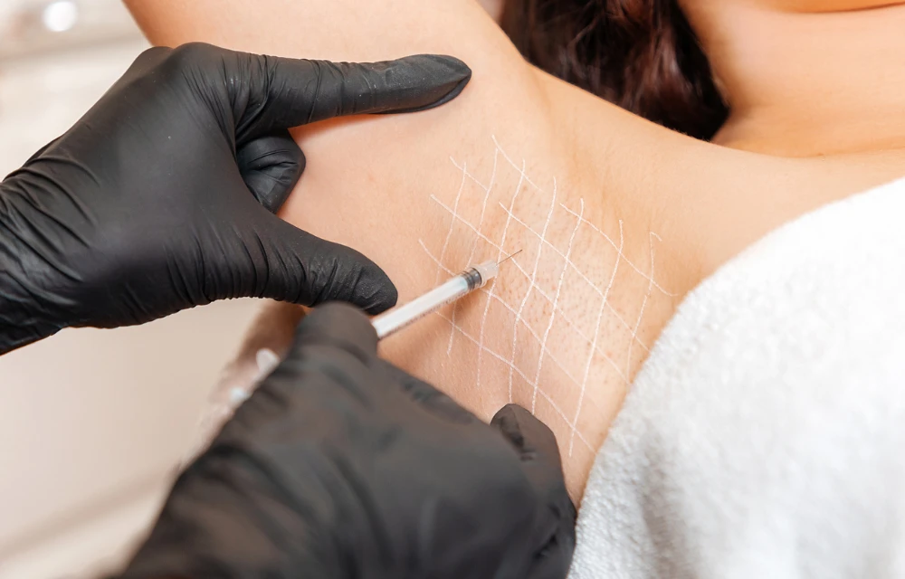 Botox for Excessive Sweating: Does It Really Work?