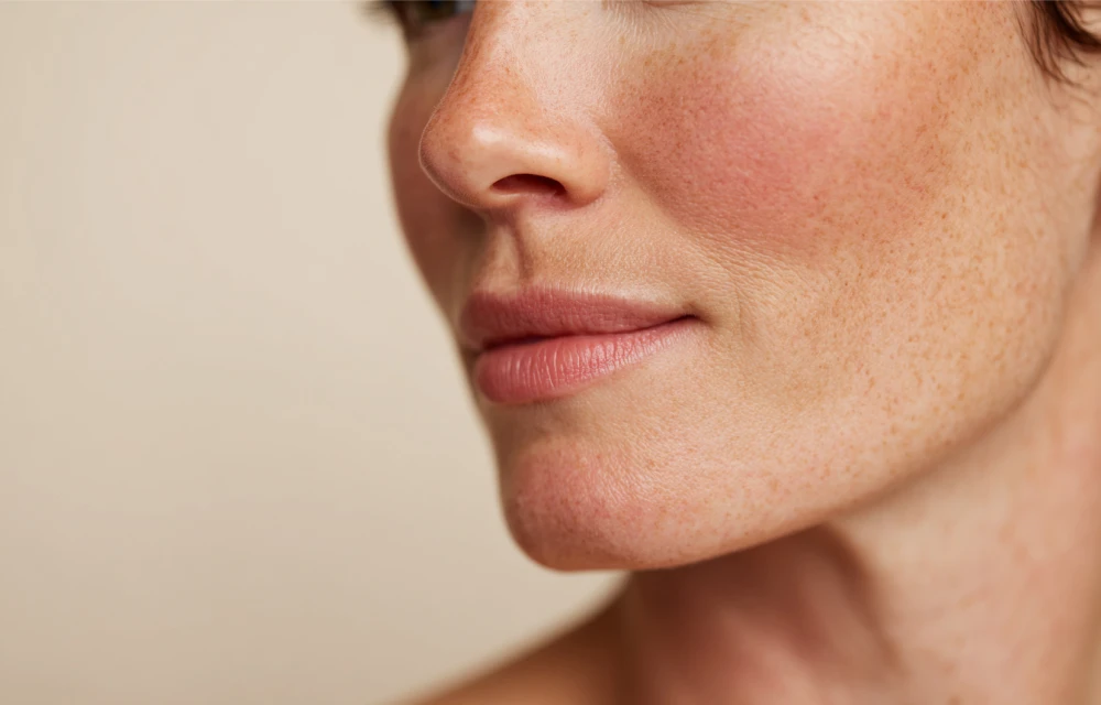 How to Treat Rosacea: Symptoms, Triggers, and the Best Treatment Options