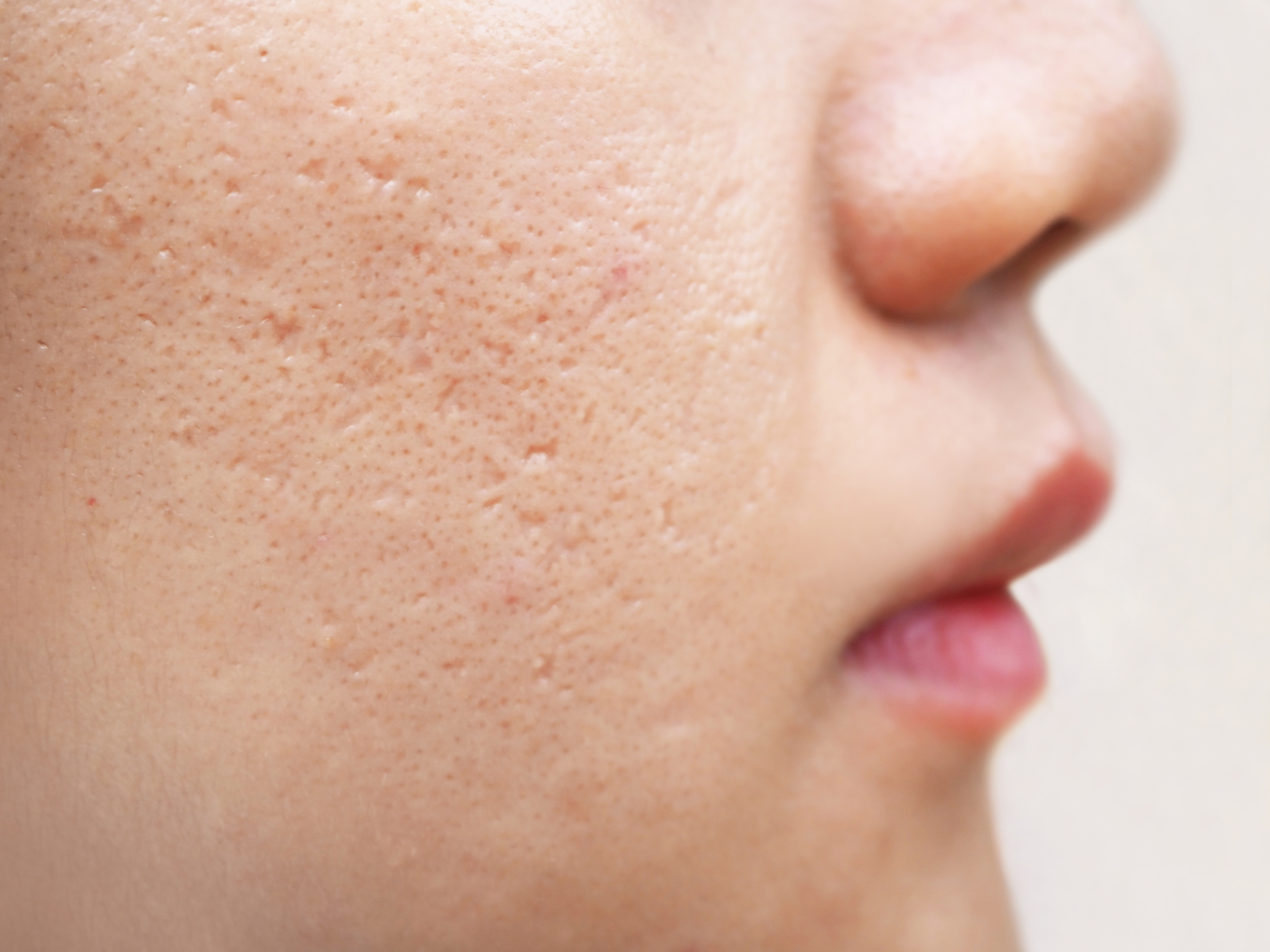 Acne scarring treatment