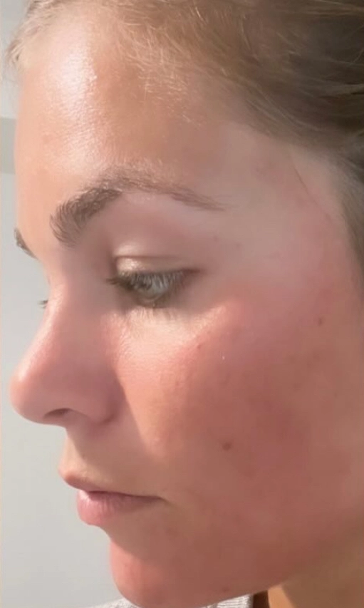 Chemical peel result — after