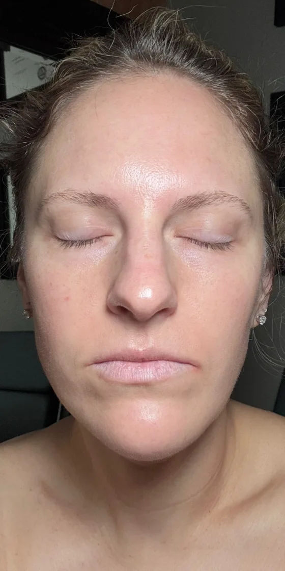 Chemical peel result — after