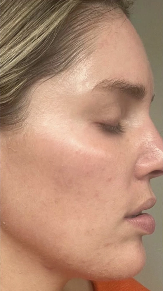 Chemical peel result — after