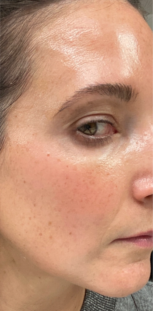 Chemical peel result — after