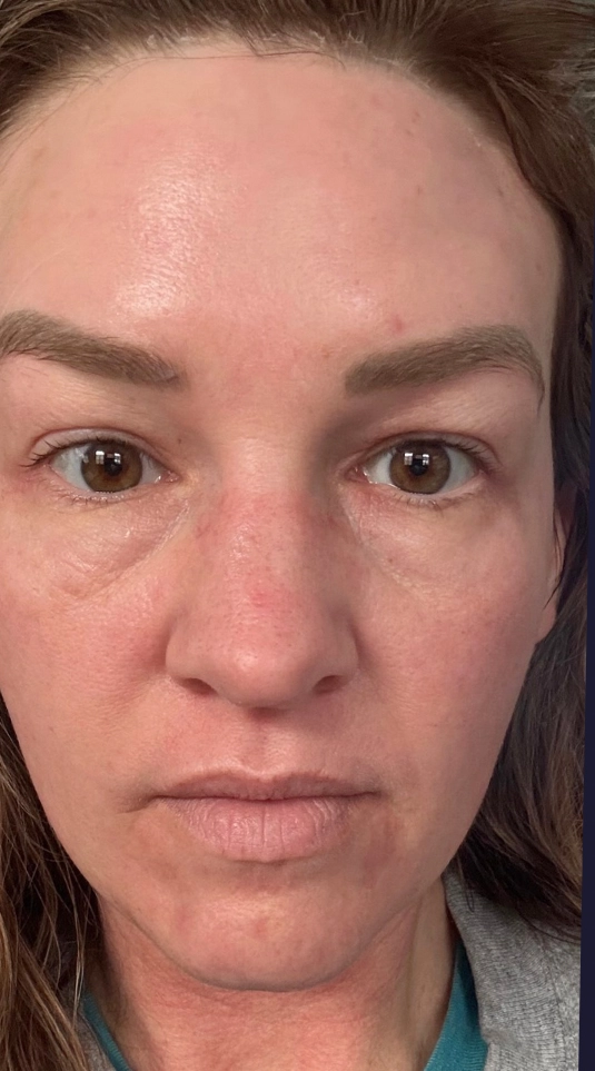 Chemical peel result — after