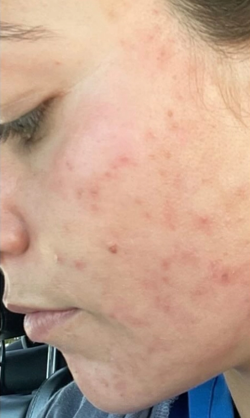 Chemical peel result — before
