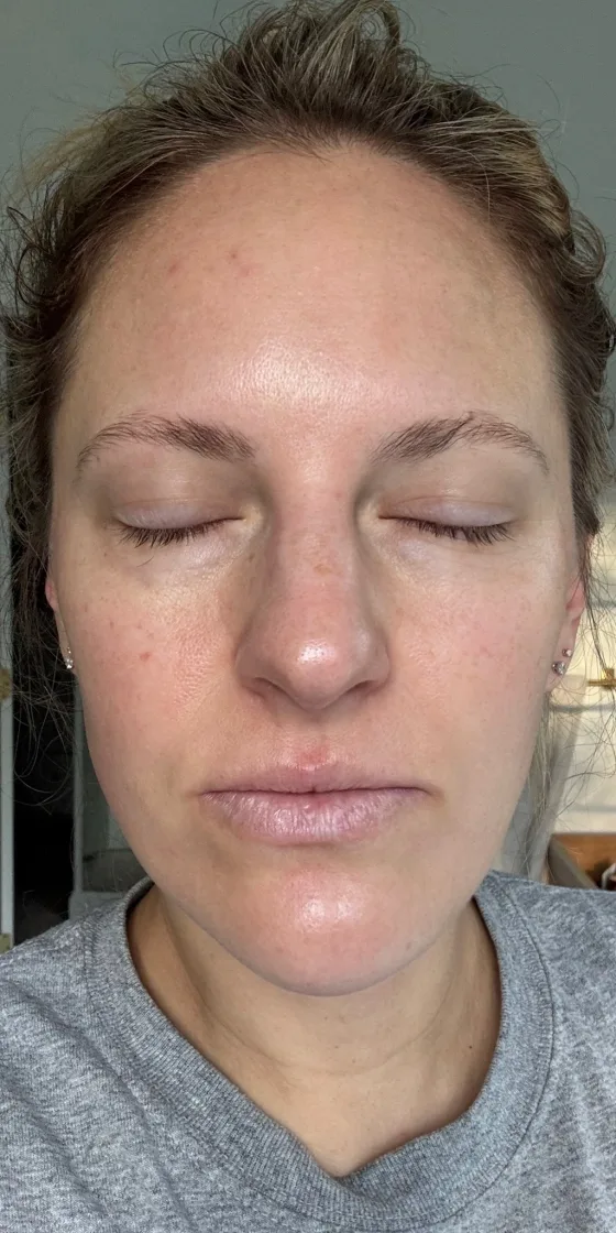 Chemical peel result — before