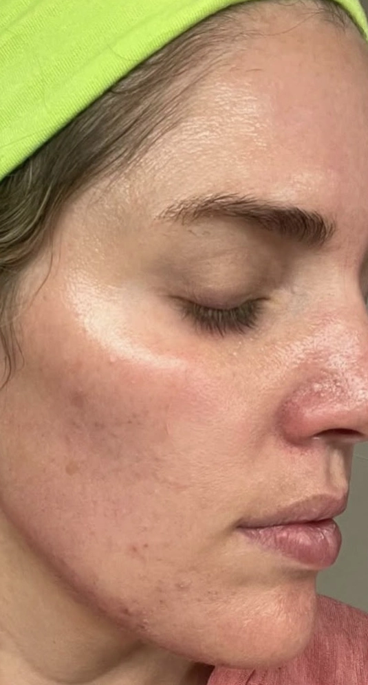 Chemical peel result — before