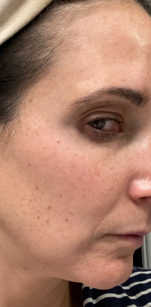 Chemical peel result — before