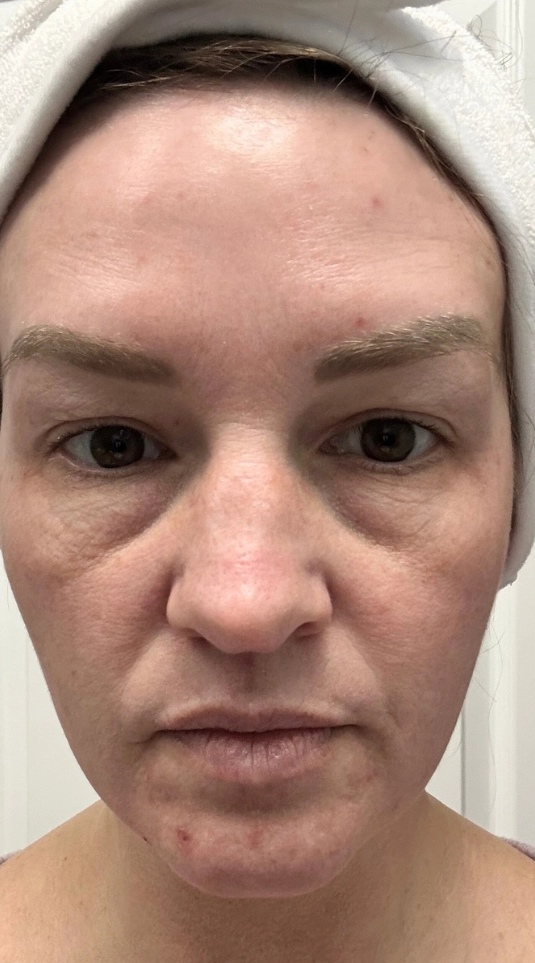 Chemical peel result — before