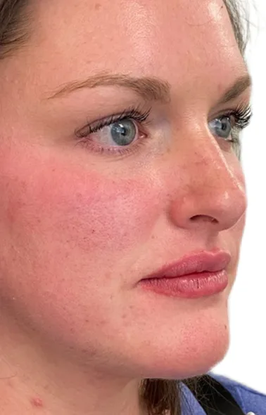 Dermal filler — before and after — after