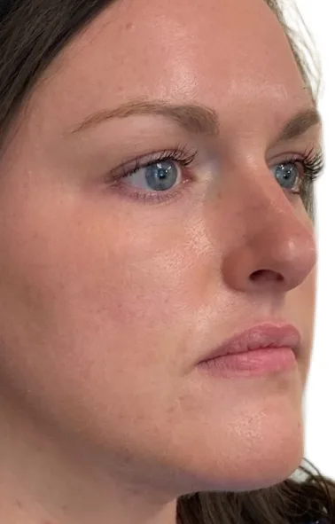 Dermal filler — before and after — before