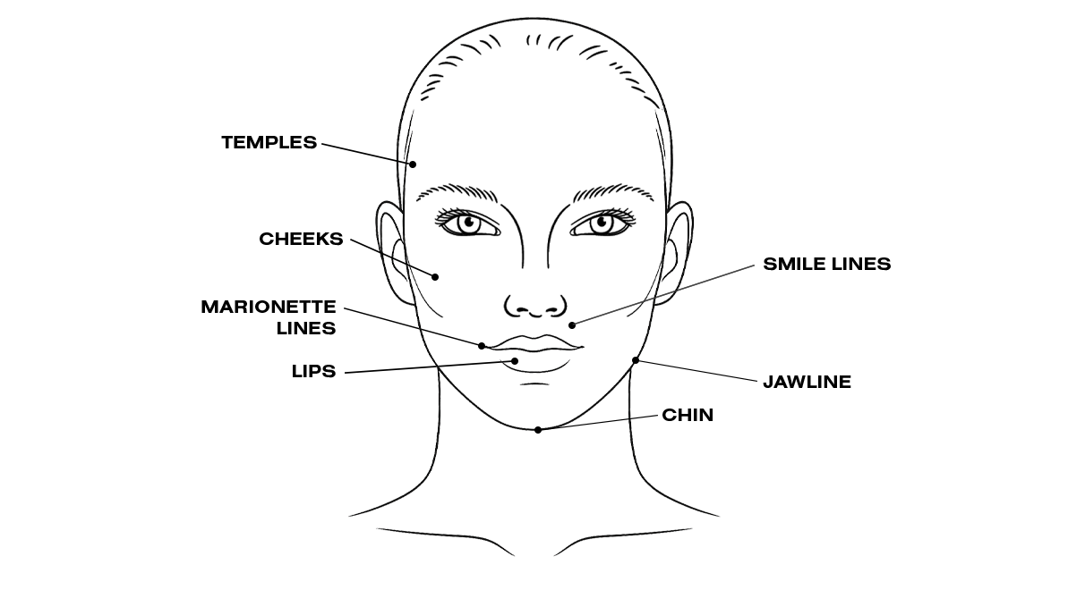 Dermal filler treatment areas of the face