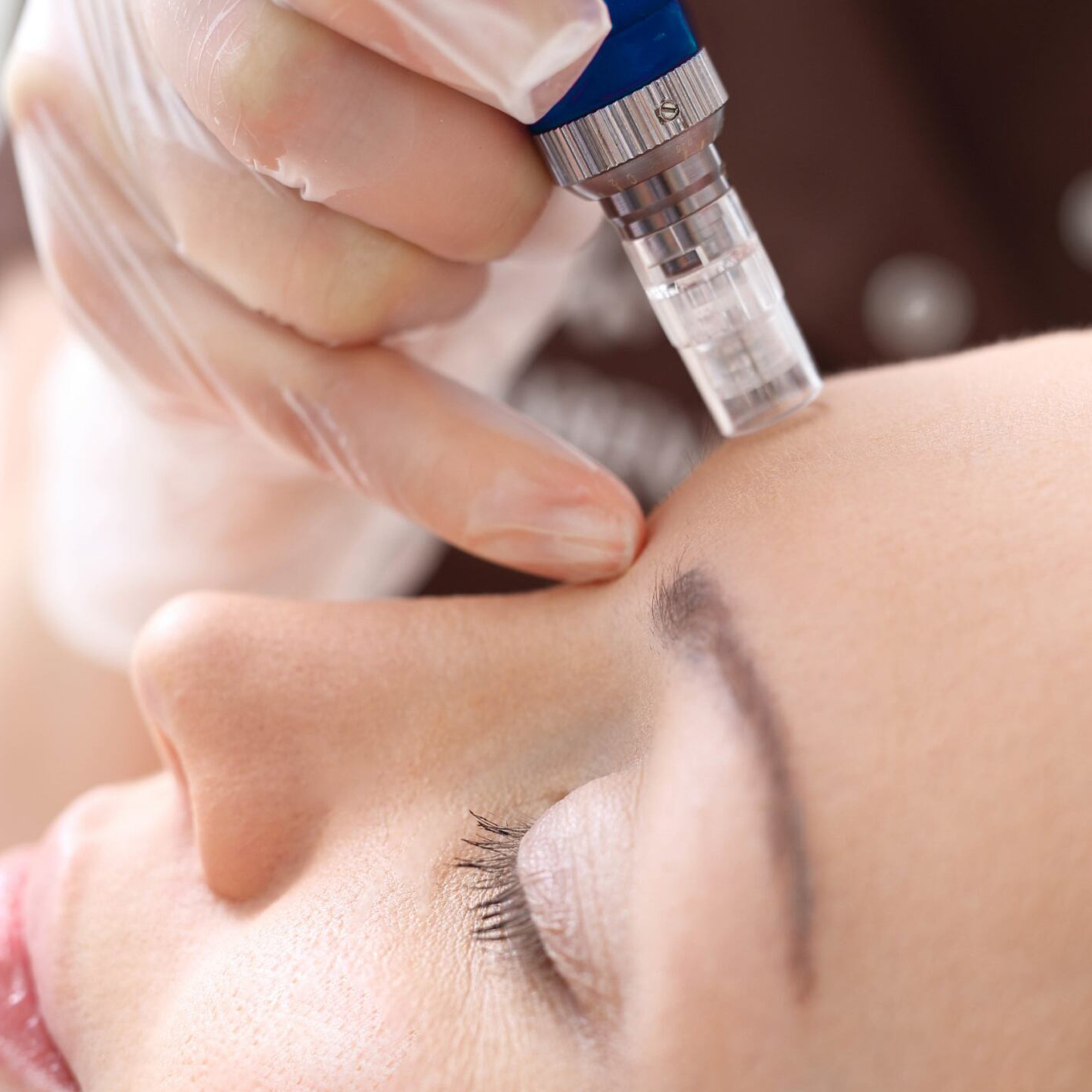 Microneedling