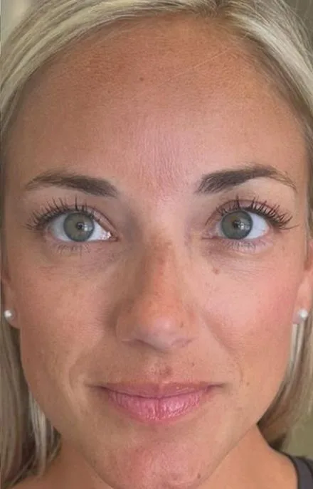 PDGF under-eye — before and after — after