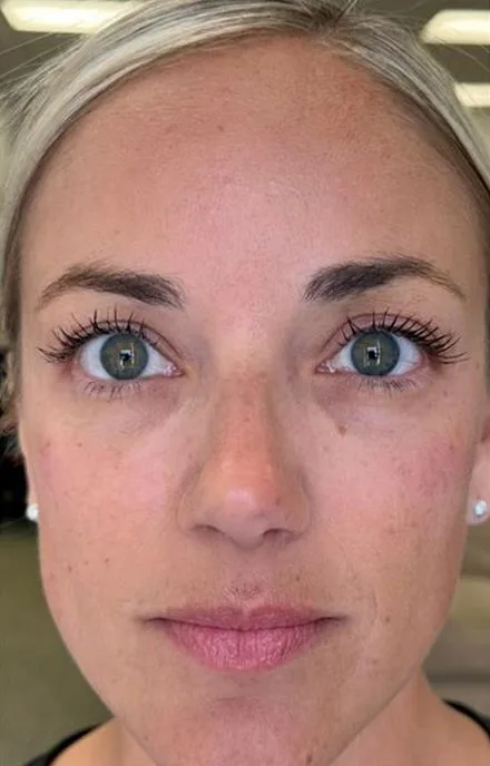 PDGF under-eye — before and after — before