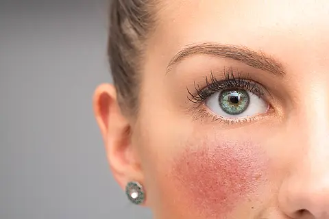 Rosacea Prescriptions