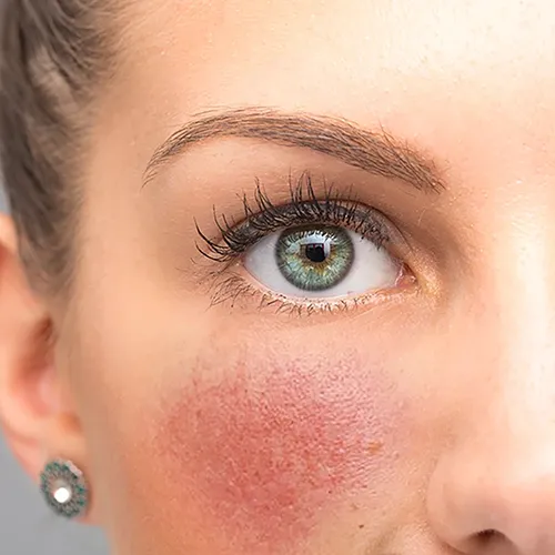 Rosacea consultation
