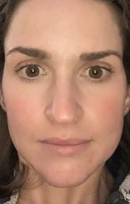 Forehead and brow lines — before and after tox — after