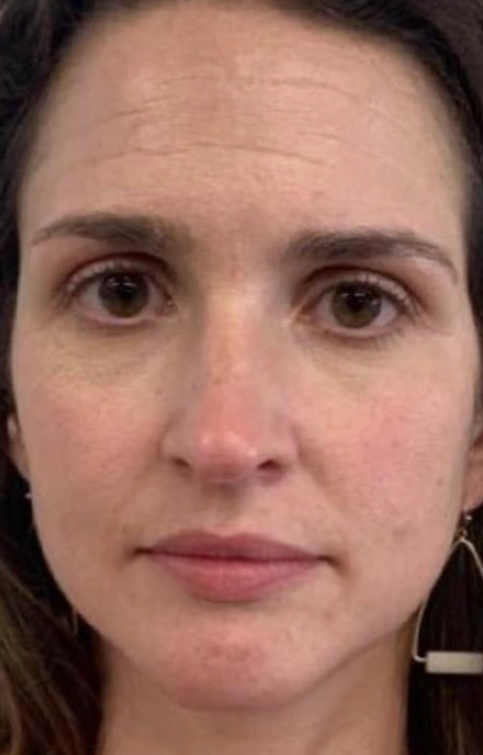 Forehead and brow lines — before and after tox — before